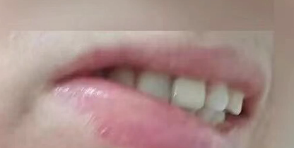 经过医生诊断,林女士右侧颊粘膜被蜈蚣咬伤,上下嘴唇肿胀的比较厉害.