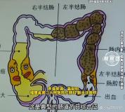 男子便秘后挤出10厘米直肠 假期综合征警钟