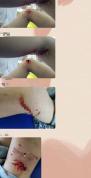 湖南多人连续4小时遭同一只狗咬伤 6岁女童受伤住院