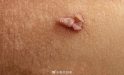 男子手上长肉芽剪掉又长疑感染HPV 拖延不治变花戒