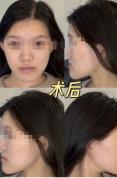女子正颌被做成鞋拔子脸 官方介入 手术失误引发争议