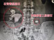 女子右肾藏结石贸然碎石险酿大祸 乱投医险入“鬼门关”