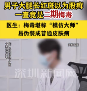 男子大腿长红斑以为是股癣 一查是梅毒