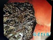 女孩腹痛恶心竟是因为偷偷吞毛发 警惕长发公主综合征