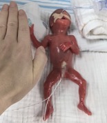 全国最小胎龄超早产儿现状 单亲妈妈坚强守护