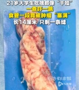 21岁大学生吃什么都像“干噎”，一查发现一段食管竟被肿瘤“塞满”