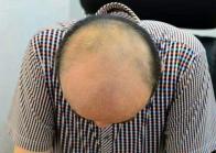 “头顶大事”了解吗？防脱发应该这样做