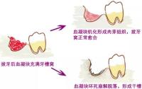 女子拔牙后當(dāng)晚就刷牙,，還用舌頭舔傷口喝粥突覺(jué)混著糞便般的腐臭 干槽癥警示錄