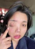 安徽女子左眼失明办证被拒 单眼失明难获认证