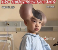 3歲男孩患先天性巨痣植入擴(kuò)張器治療 媽媽回應(yīng)