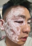 男子用餐廳毒紙巾擦臉皮膚嚴重過敏 劣質(zhì)紙巾隱患大
