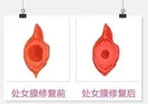 价格详情：重庆处女膜修复私密医院收费标准“公开透明”重庆军科整形美容医院处女膜修复手术价格合理正规