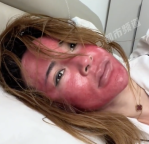 37岁女子长期不卸妆皮肤出问题 22年未卸妆引发严重过敏