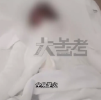 10岁男孩烧杨絮引爆油桶特重烧伤 妈妈心如刀割