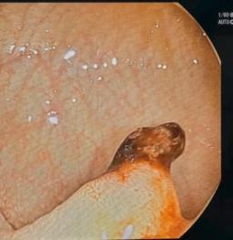 家长揪息肉致男孩肛门大出血 医生跪床紧急止血