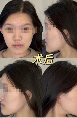 女子正颌被做成鞋拔子脸 官方介入