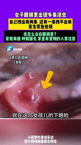 女子眼痒竟从眼睛里取出两条活虫 结膜吸吮线虫作祟