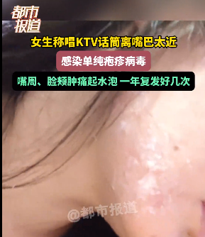 女子唱K離話筒太近感染病毒