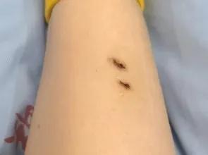 女子躺酒店床上被毒蛇咬伤 后遗症持续2年