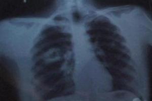 肺结核的早期症状 怎样治疗肺结核