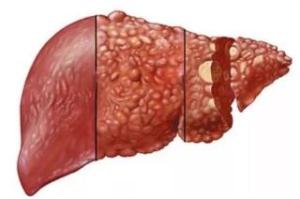 肝脓肿的病因有什么 肝脓肿的症状有哪些
