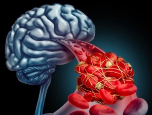 脑出血后脑积水如何治疗 脑出血会有后遗症吗