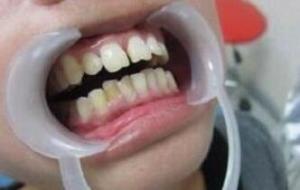 牙龈出血的原因有哪些 牙龈出血危害大