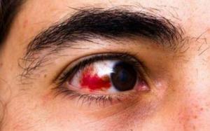 红眼病的症状有哪些 怎样预防红眼病