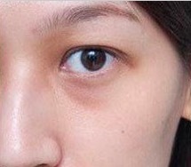 黑眼圈的治疗方法 怎么治疗黑眼圈偏方大全