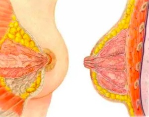 乳腺癌有哪些治疗方案 乳腺癌术后可再造乳房吗
