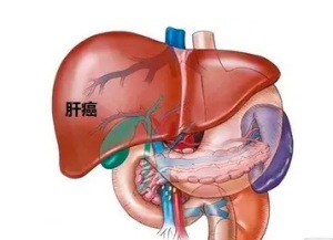 肝癌结节破裂出血该怎么办 最新肝癌治疗方法有哪些