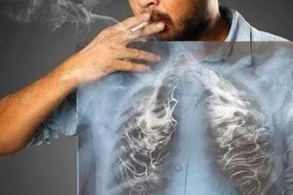 肺癌晚期不宜长期卧床 详解肺癌常见三大疗法