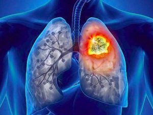 导致肺癌的杀手有哪些 肺癌生物靶向治疗是什么
