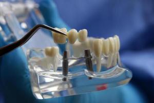 国家调控种植牙医疗服务价格 目标为一颗牙4500元