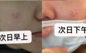 网友曝在赫莲娜做护理致脸部烧伤 店员：美容师已停职半月