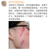 毒液堪比硫酸 一地确诊200多例！防护指南来了