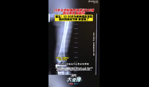 13岁女孩骨癌误当生长痛终被截肢 医生：12-20岁为骨肿瘤高发期 夜间持续关节疼 要警惕了