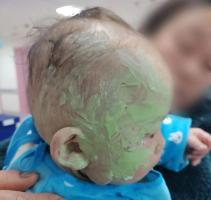 1岁婴儿跌入火盆烧伤 家长涂满牙膏 错误处理险些加重伤情