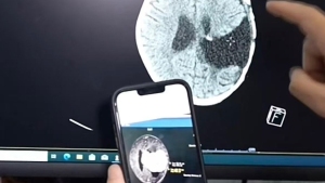 5岁女童颅内长10厘米巨瘤大过拳头 医生18小时手术成功切除