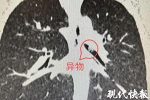 4岁娃突然呼吸困难双手掐脖子满脸通红 医生发现玩具卡在气管