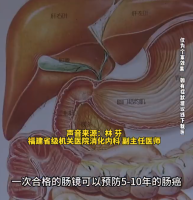 一级亲属有肠癌史本人风险高2倍 一次合格肠镜可防5-10年肠癌