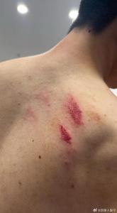 广州队门将背部照片：两道血印，赛中受伤引热议