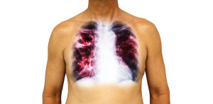 医生：查出肺结节不用过分焦虑 明确诊断，对症治疗即可