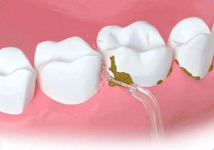 专家称彻底清洁牙齿要靠水流，刷牙时间一般应控制在3分钟左右