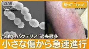 罕见“食人细菌”在日本蔓延 致死率高达40%
