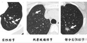 肺CT报告15条“暗语”，出现这些字眼别大意