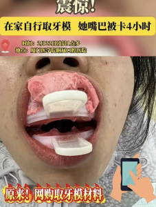 女子自取牙模拿錯(cuò)材料嘴被石膏焊死 DIY牙模風(fēng)險(xiǎn)大