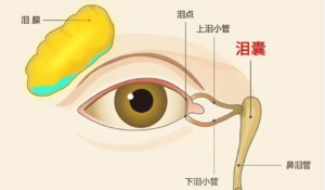 女子右眼狂飆淚竟是瘤子長進(jìn)淚囊里,！醫(yī)生6小時聯(lián)合手術(shù)緊急切除！