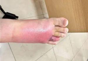 男子在沙發(fā)上睡一覺后差點(diǎn)截趾 昆蟲咬傷引發(fā)蜂窩織炎