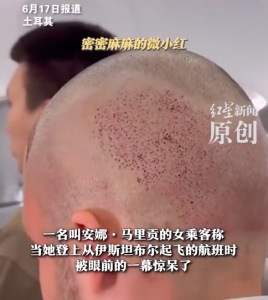 網(wǎng)友乘機偶遇一群植發(fā)后的光頭男驚呆了